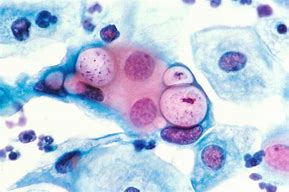 Image result for Chlamydia in Urine