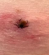 Image result for Tick Attached to Skin