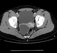 Image result for 6 Cm Cyst On Ovary