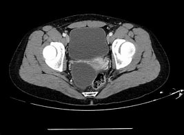 Image result for Ovarian Cyst Cancer