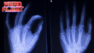 Image result for X-ray of Knuckles Cracking