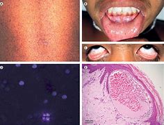 Image result for Monisia Disease