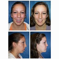 Image result for TMJ Therapy Chin Before and After