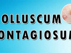 Image result for Molluscum Contagiosum Curettage