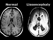 Image result for Lissencephaly Patho
