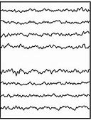 Image result for Normal EEG Tracing