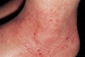 Image result for Eczema Rash Symptoms