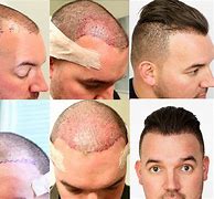 Image result for Hair Transplant Receding Hairline