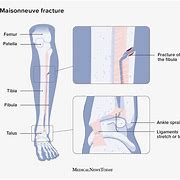 Image result for Maisonneuve Fracture