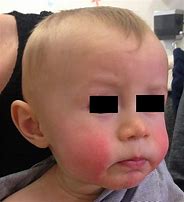 Image result for 3 Month Old Baby Parvovirus B19