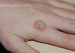 Image result for Small Finger Wart