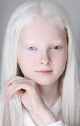 Image result for Albino Human Eye Color