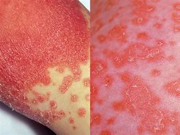 Image result for Chlamydia Skin Lesions