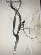 Image result for Carotid Angiogram