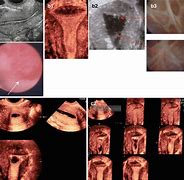 Image result for Uterine Polyp Size Chart