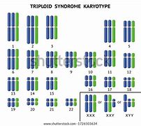 Image result for Triploid Syndrome Human