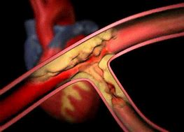 Image result for Ruptured Carotid Artery Aneurysm