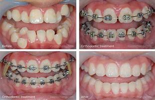 Image result for Dental Braces