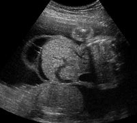 Image result for Omphalocele On Ultrasound