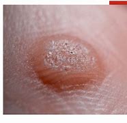 Image result for Common Warts Pictures