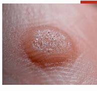 Image result for HPV On Feet