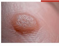 Image result for Sole Warts
