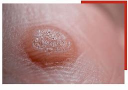 Image result for Types of Warts On Hands