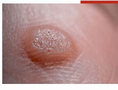 Image result for Wart Pics