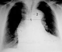 Image result for Aortic Dissection On Chest X-Ray