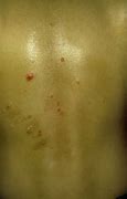 Image result for Molluscum Dermatitis