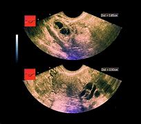 Image result for 10 Cm Cyst On Ovaries Ultrasound