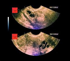 Image result for 13 Cm Ovarian Cyst