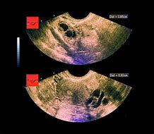 Image result for 20 Cm Ovarian Cyst