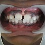 Image result for X-ray Cleft Palate