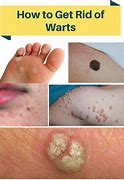 Image result for Warts On Abdomen