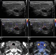 Image result for Parathyroid Masses On Ultrasound