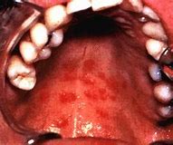 Image result for HIV Oral Lesions