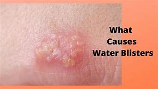 Image result for Water Blisters On Skin