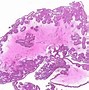 Image result for Sinonasal Papilloma Inverted Type Gross