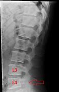 Image result for Labeled AP Lumbar Spine X-ray