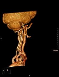 Image result for Carotid Tumor Neck