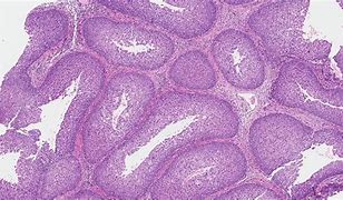 Image result for What Is an Inverted Papilloma