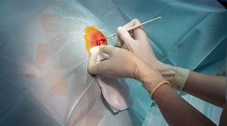 Image result for How Big Is 4 Centimeter Cyst