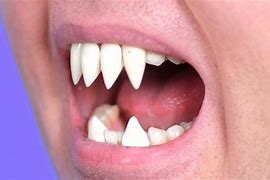 Image result for Blunt Sharp Teeth