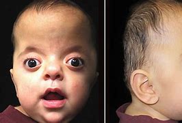 Image result for Apert Syndrome
