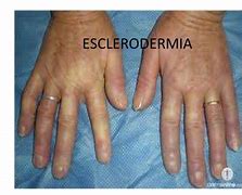 Image result for esclerodermia