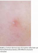 Image result for Eruptive Vellus Hair Cysts to Steotocystoma