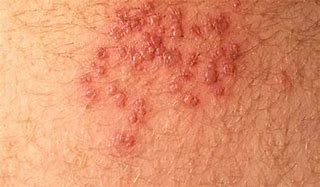 Image result for HIV Lesions On Skin
