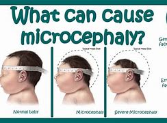 Image result for Congenital Microcephaly