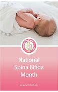 Image result for Spina Bifida Prevention